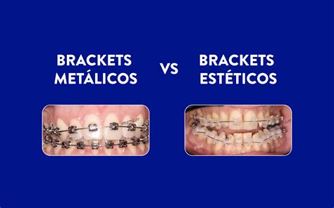 Brackets transparentes versus brackets metálicos: 